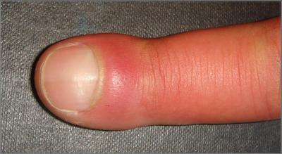 Researchers Say PGE2 Is Behind The Puzzling Medical Condition 'Finger Clubbing'